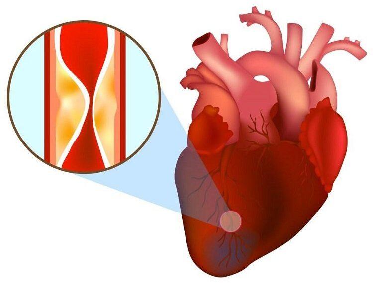 Cholesterol trong máu cao có gây bệnh tim mạch không?